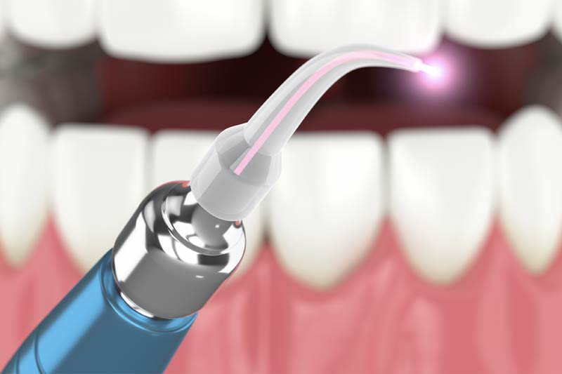 Laser Dentistry in Fort Worth
